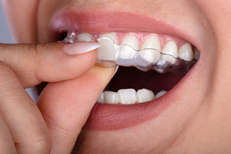Associates in Dentistry | Reveal reg Clear Aligners, Oral Exams and Root Canals